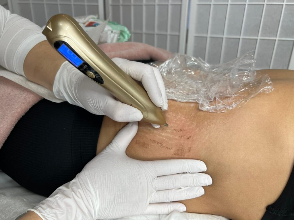 Plasma pen