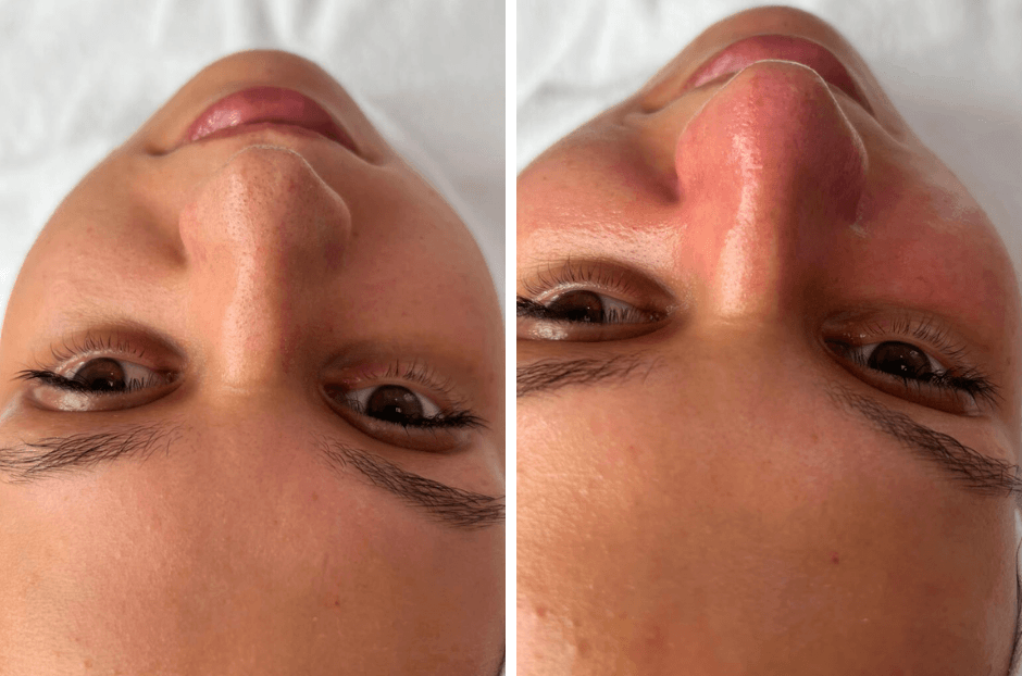 HydraFacial – čišćenje lica prije i poslije 
