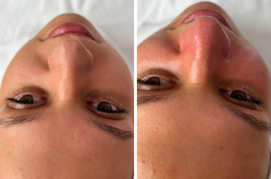 HydraFacial – čišćenje lica prije i poslije 