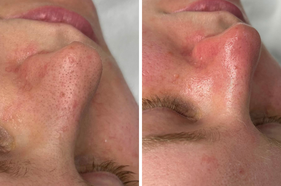 HydraFacial tretman – čišćenje lica
